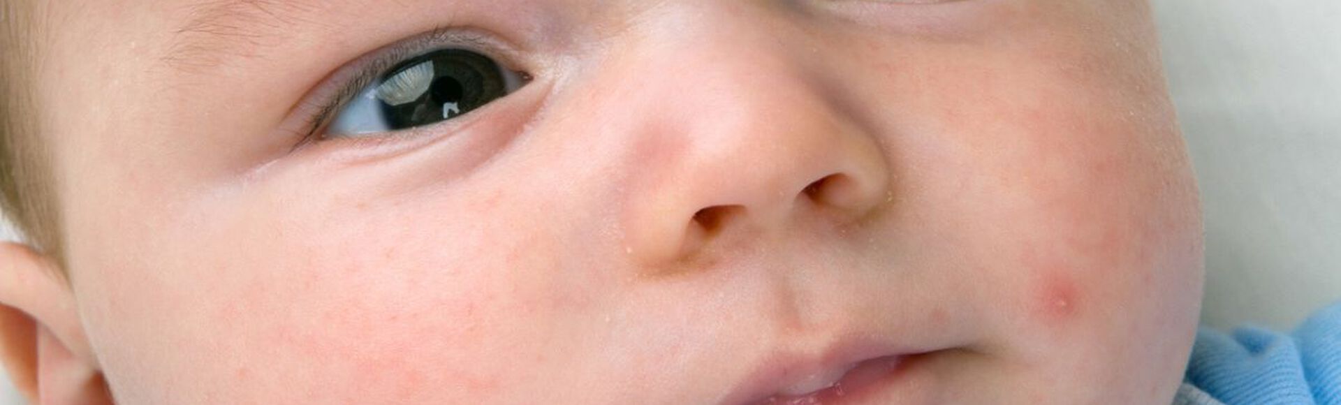 bebê com espinhas no rosto