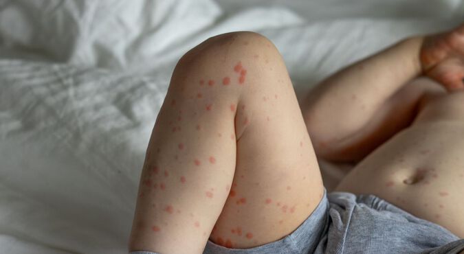 Pernas de criança pequena com manchas avermelhadas tipicas da roseola infantil