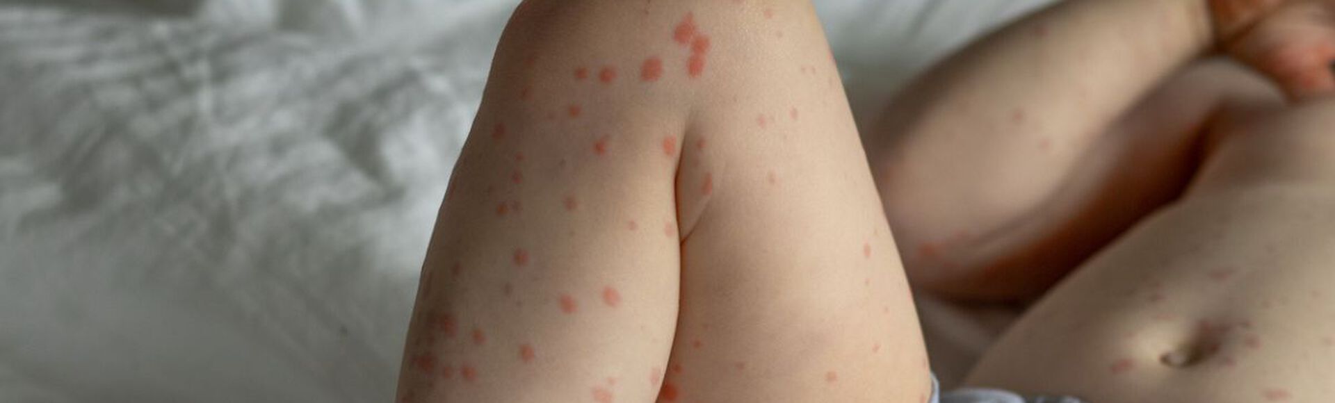 Pernas de criança pequena com manchas avermelhadas tipicas da roseola infantil