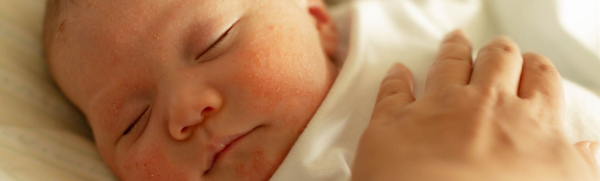 Bebê com alergia na pele