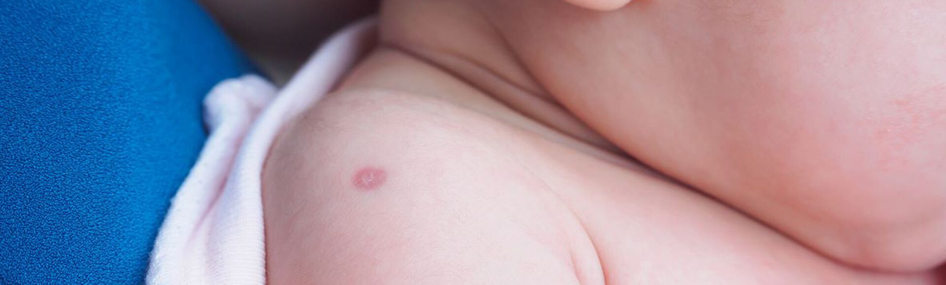 Bebê com cicatriz de vacina BCG no ombro.