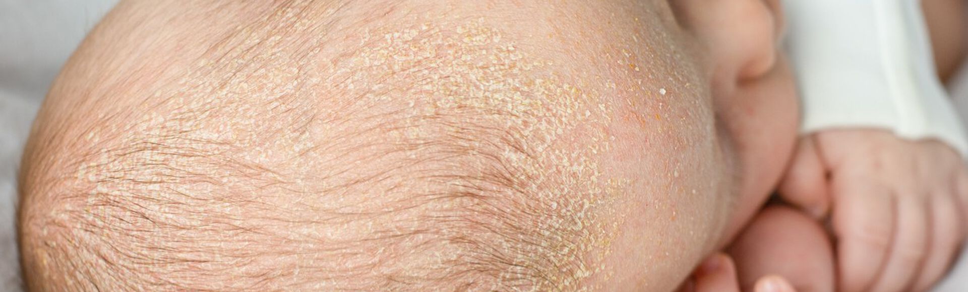 Bebê deitado visto de cima deixando cabeça com crosta láctea evidenciada através de descamação esbranquiçada em destaque