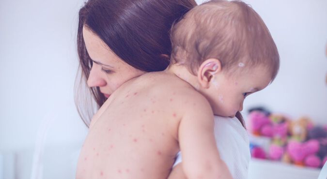 Mãe abraçando bebê com manchas no corpo
