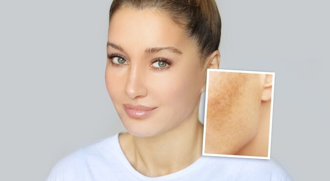 Mulher com melasma no rosto