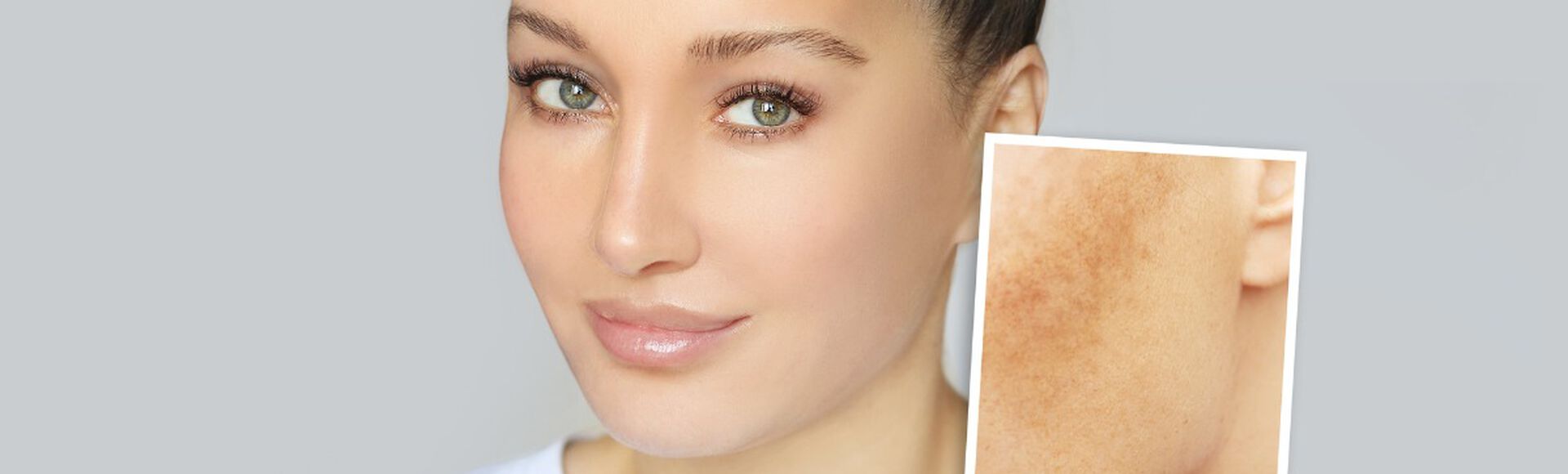 Mulher com melasma no rosto