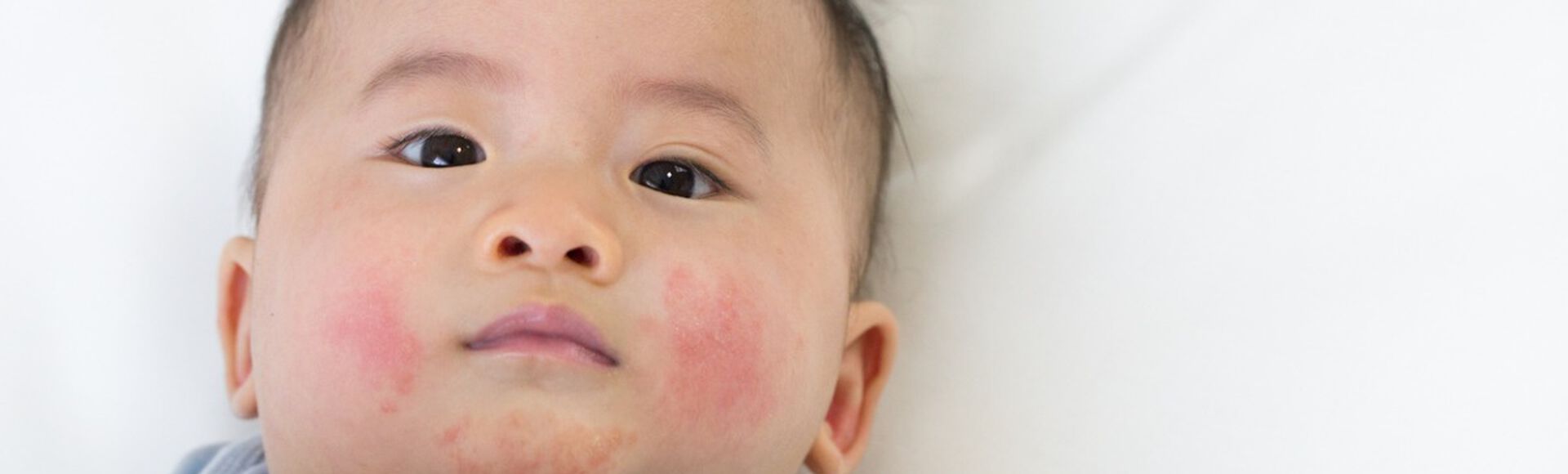 Bebê com bochechas avermelhadas com rash cutâneo