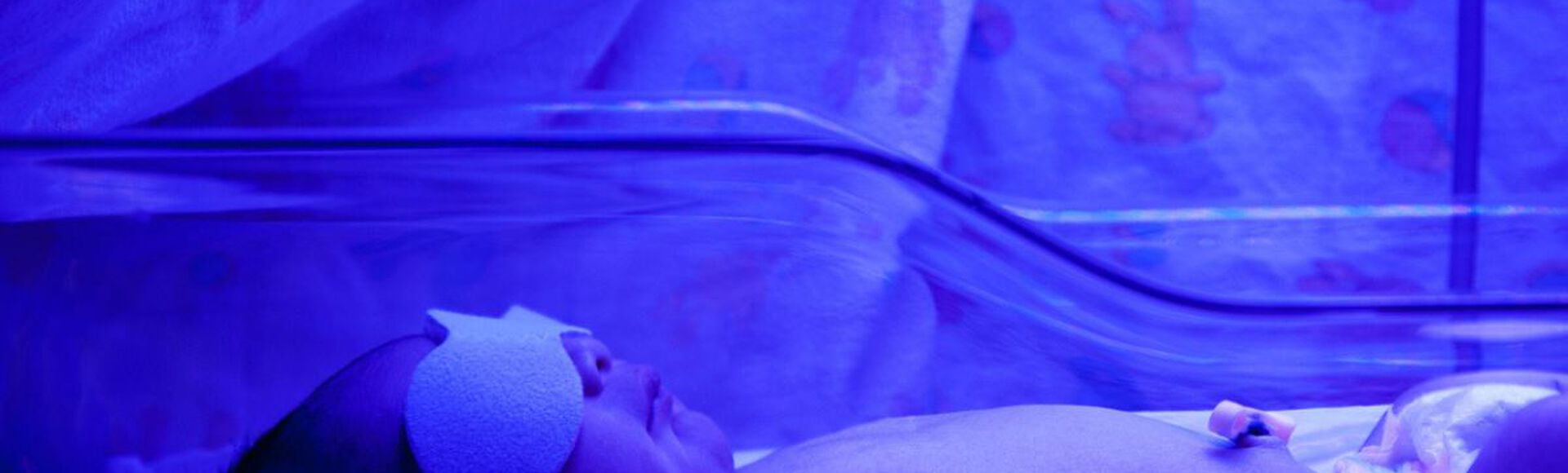 Bebe recem-nascido com tapa-olho recebendo fototerapia de luz azul