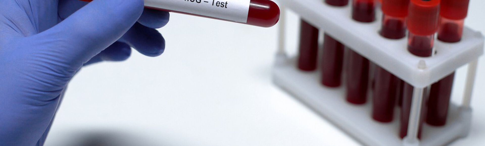 Mão com luva segurando um tubo de ensaio de exame Beta hCG