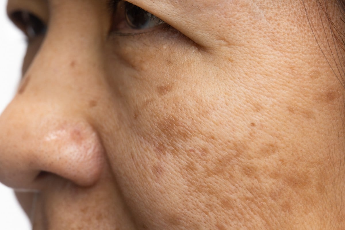 mulher com melasma no rosto