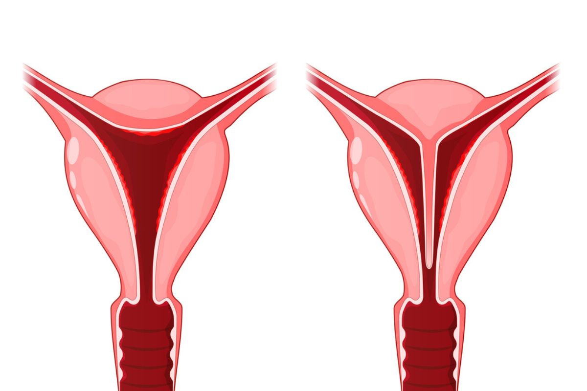 Ilustra que mostra um útero normal e um útero bicorno, com um septo dividindo parcialmente a cavidade uterina