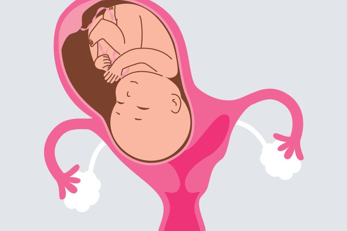 Ilustração de gravidez com útero bicorno, que mostra bebê desenvolvendo-se apenas de um lado do útero